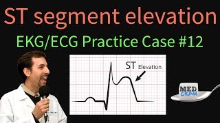 ST Elevation  EKG  ECG Interpretation Case 12 STEMI MI ACS [upl. by Marti524]