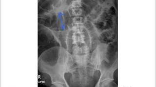 Small bowel obstruction [upl. by Greiner863]