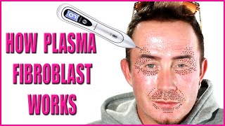 Plasma Fibroblast  How Fibroblast Plasma Works Beneath the Skin [upl. by Niuqaoj999]