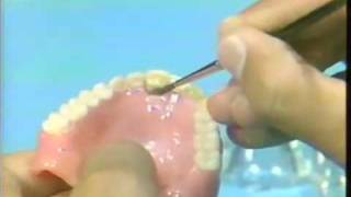 Replacing a Broken Complete Denture Tooth [upl. by Kcirdneh]