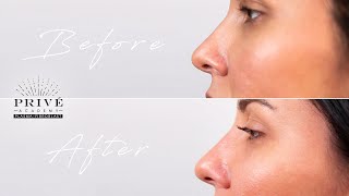 Plasma Fibroblast  Prive Academy  Nose Contouring Technique [upl. by Barker]