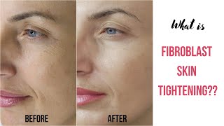 What is Fibroblast Skin Tightening [upl. by Molloy]