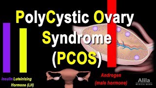 Polycystic Ovary Syndrome PCOS Pathology and Treatment Animation [upl. by Minni]