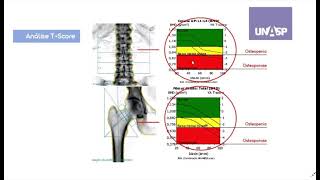 Densitometria óssea e osteoporose [upl. by Katerina910]