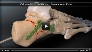 Calcaneal Fracture Percutaneous Plate [upl. by Airednaxela]