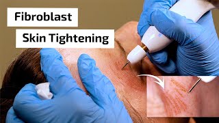 What is Fibroblast Skin Tightening  Prime Plasma [upl. by Lanam706]