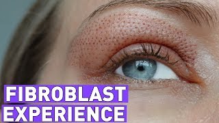 FIBROBLAST treatment experiencebefore and after 7 days [upl. by Sitoeht]