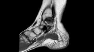 Ankle MRI anatomy [upl. by Assennav642]