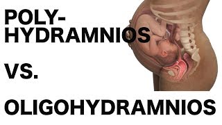 Polyhydramnios vs Oligohydramnios [upl. by Engelhart140]