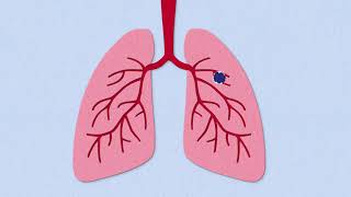 Fibrosis Explained [upl. by Briny]