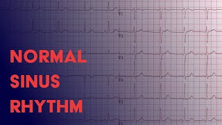 Normal Sinus Rhythm  EKG ECG Interpretation [upl. by Bonaparte178]