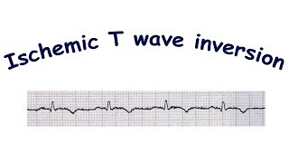 Mechanism of ischemic T wave inversion [upl. by Naylor]