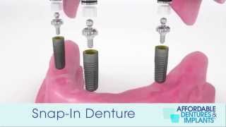 Demo How Do SnapIn Dentures With Implants Work [upl. by Selby904]