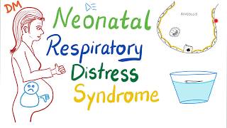 Neonatal Respiratory Distress Syndrome NRDS  Pediatrics  Pulmonology [upl. by Acinoryt]